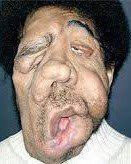 Tumour due to nuclear radiation